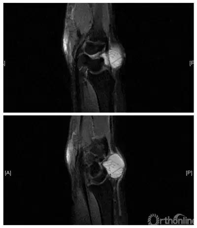 手腕囊肿抽吸出来后可否继续按压,足背囊肿穿刺好还是切除好