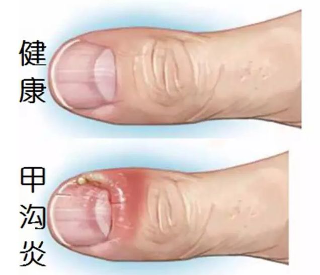 跑步跑出黑指甲怎么处理,跑步脚上出现黑趾甲该怎么处理