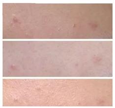 爆痘闭口做什么项目,爆闭口怎么办