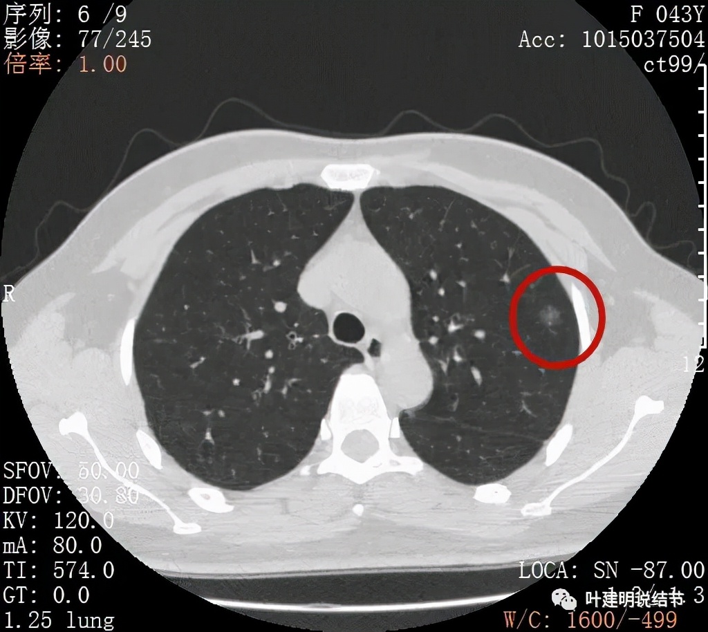 怎样从病理报告看是不是原位癌,原位腺癌切除子宫要开刀吗