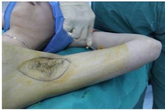 手术治疗狐臭需要住院吗,治疗狐臭手术应挂什么科