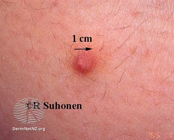 褐色皮肤纤维瘤会癌变吗,皮肤里面有个小的肿块会是什么