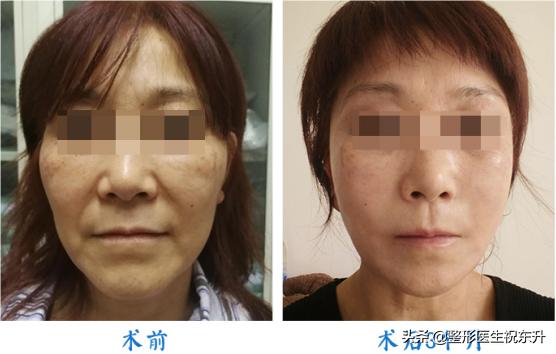 55岁如何做面部提升术好,40岁适合哪种面部提升手术