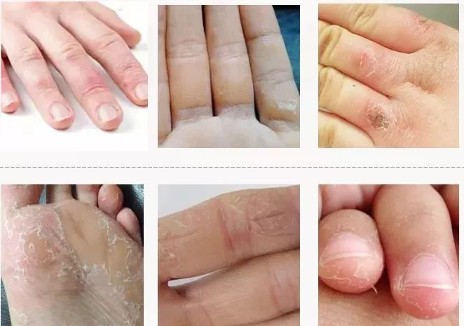 冬天脚后跟干裂用什么润脚霜,润足脚后跟干裂修复霜