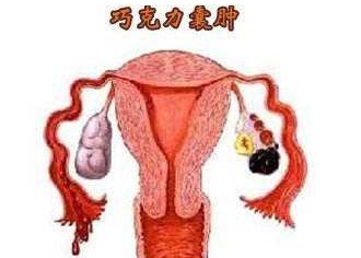 卵巢巧克力囊肿手术后多久能怀孕,卵巢巧克力囊肿变异能不能怀孕