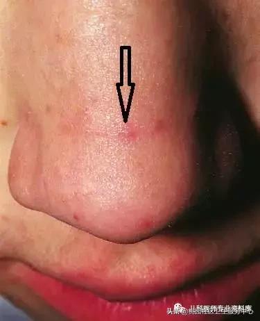 过敏性鼻炎手术的全过程,治疗过敏性鼻炎有效的药