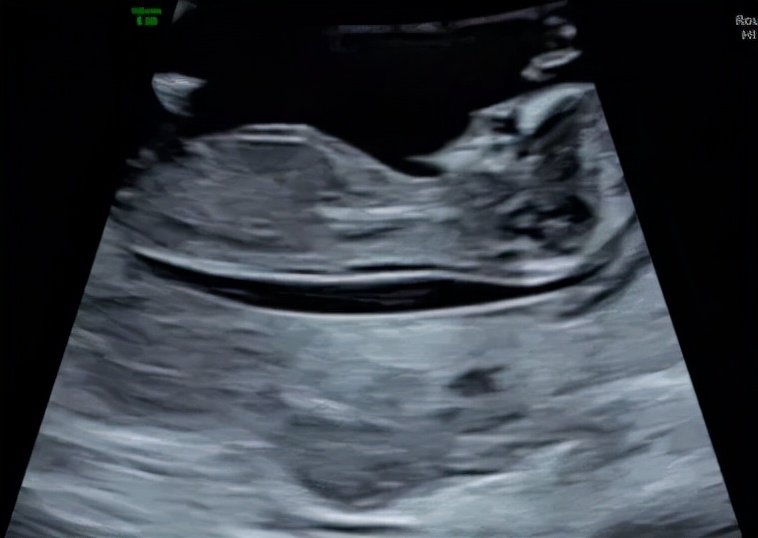 孕期超声检查须知,准妈妈必读产前超声小课堂