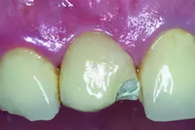 烤瓷牙基底冠如何清洁不崩瓷,烤瓷牙咬合面崩瓷必须重做吗