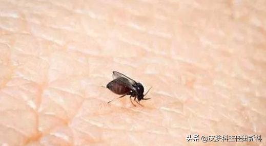 炉甘石万能药,用完炉甘石洗剂皮肤干燥怎么缓解