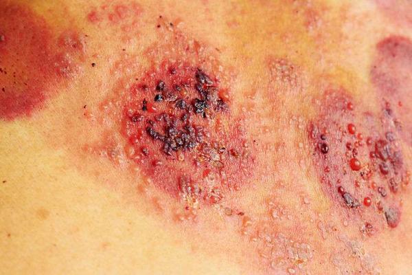 烫伤后怎么及时处理,烫伤没有烫伤药怎么处理