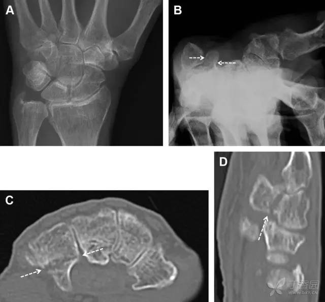 常见的八种骨折,容易漏诊的肩关节骨折
