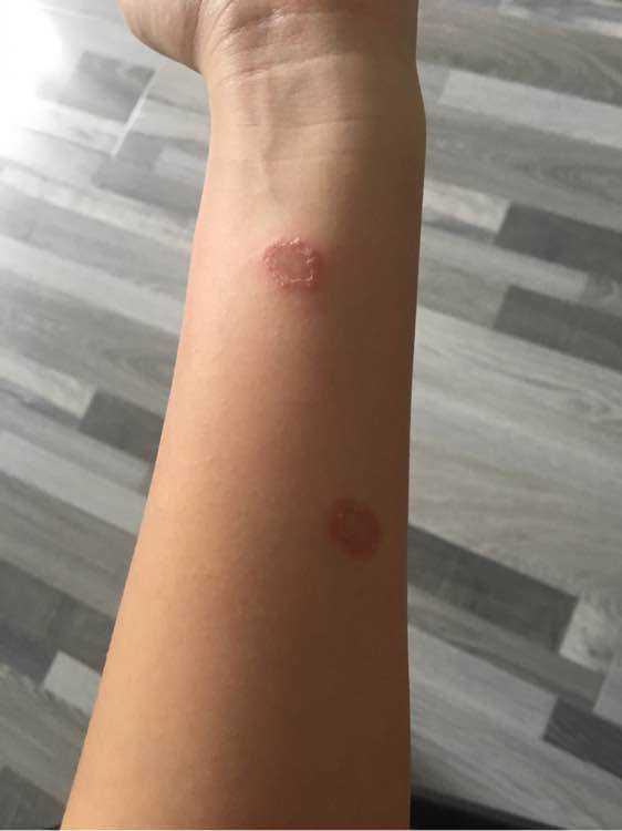 人得了猫癣怎么防止它越长越多 (猫病猫藓)