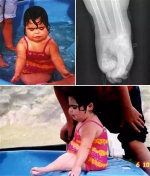 郝万山讲恐伤肾吃什么药,郝万山讲肾引起的腹水