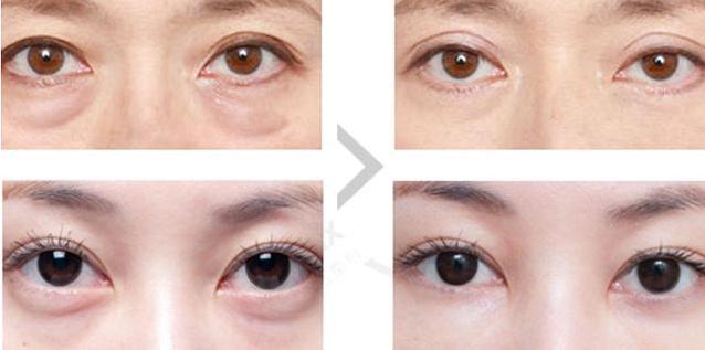 怎么遮眼纹和黑眼圈,黑眼圈眼纹很重显老怎么办