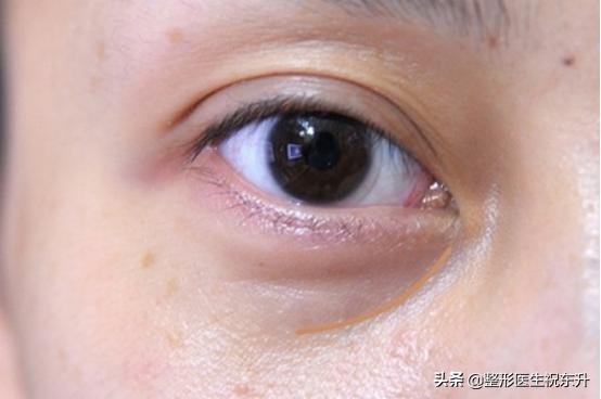填泪沟可以用自己眼袋填吗,填泪沟可以解决眼袋问题吗