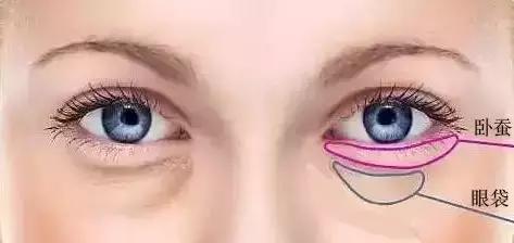 卧蚕老了是不是就是眼袋,新生儿眼袋和卧蚕的区别