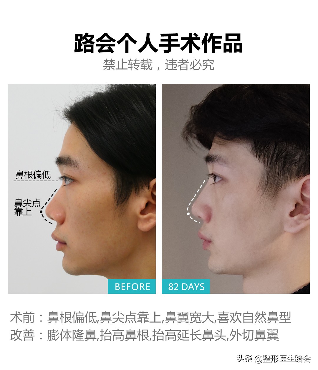 隆鼻后鼻子可以动吗,隆鼻后鼻子里可以不塞纱布吗