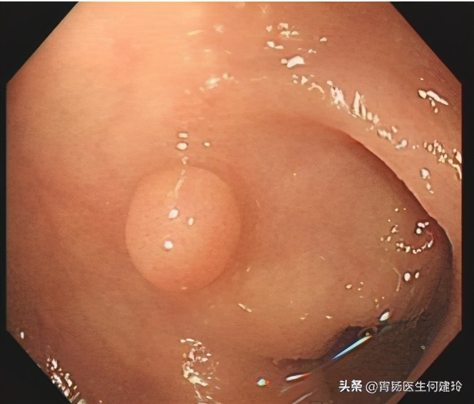 消化科医生有必要做肠镜吗,肠镜整个过程消化科医生能看到吗