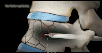 老年人压缩骨折能治好吗,腰椎压缩骨折腰部酸痛怎么办