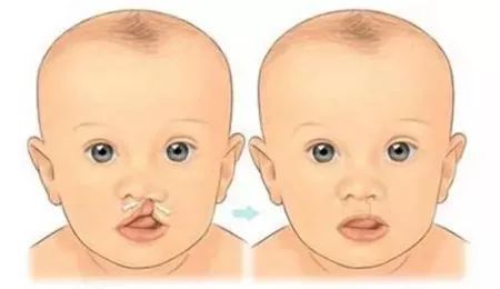 新生儿科普知识小视频,为什么我的宝宝会有唇腭裂