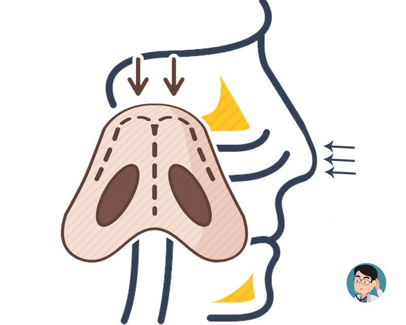 流鼻血怎么办教你一招解决,流鼻血怎么办教你一个动作