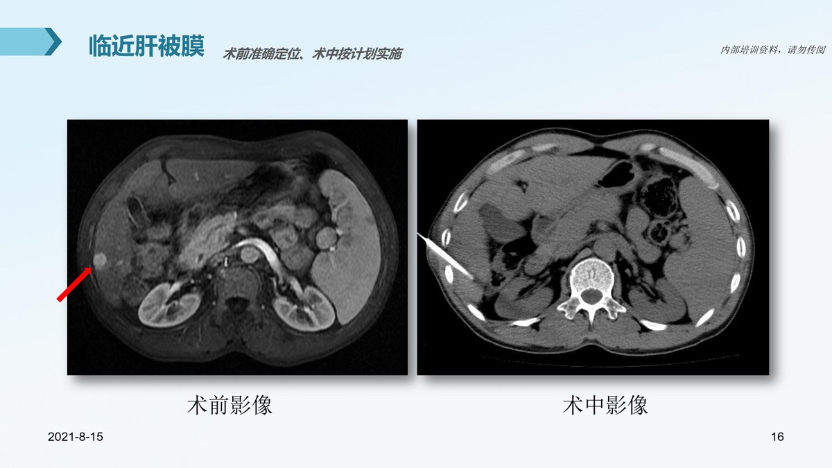 氩氦刀适合早期的肿瘤的切除么,氩氦刀肿瘤治疗新方法