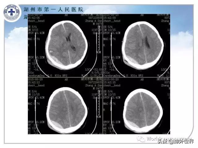 头皮裂伤缝合手术切口分类,头皮切口