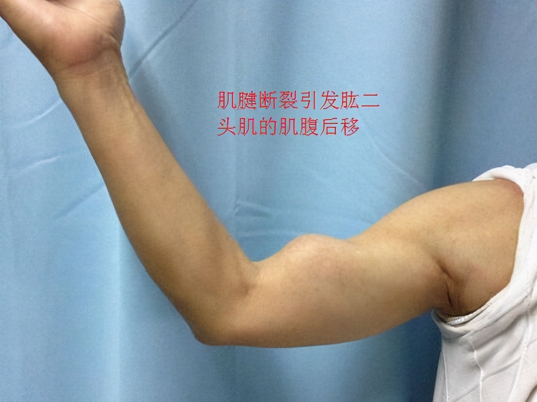 掰手腕导致肱二头肌肌腱损伤,肱二头肌肌腱损伤推拿治疗