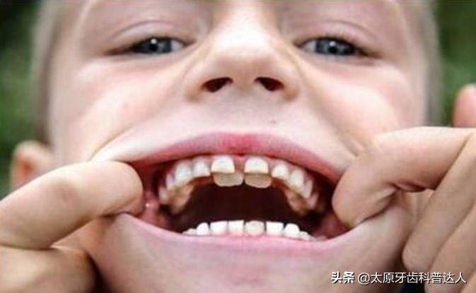 孩子双层牙了为什么不建议拔掉,为什么孩子会有双重性格