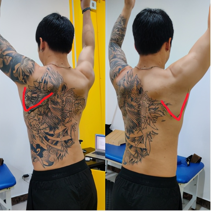 肩峰撞击肩关节疼痛怎么恢复,肩关节疼痛有可能是什么病