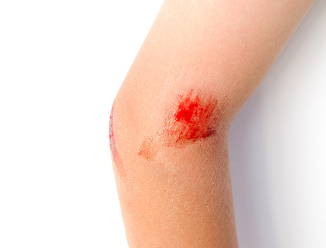 摔伤的疤痕变黑了怎样恢复,酒后脸部擦伤留下疤痕如何恢复