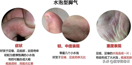 足部扁平苔藓,足癣病例