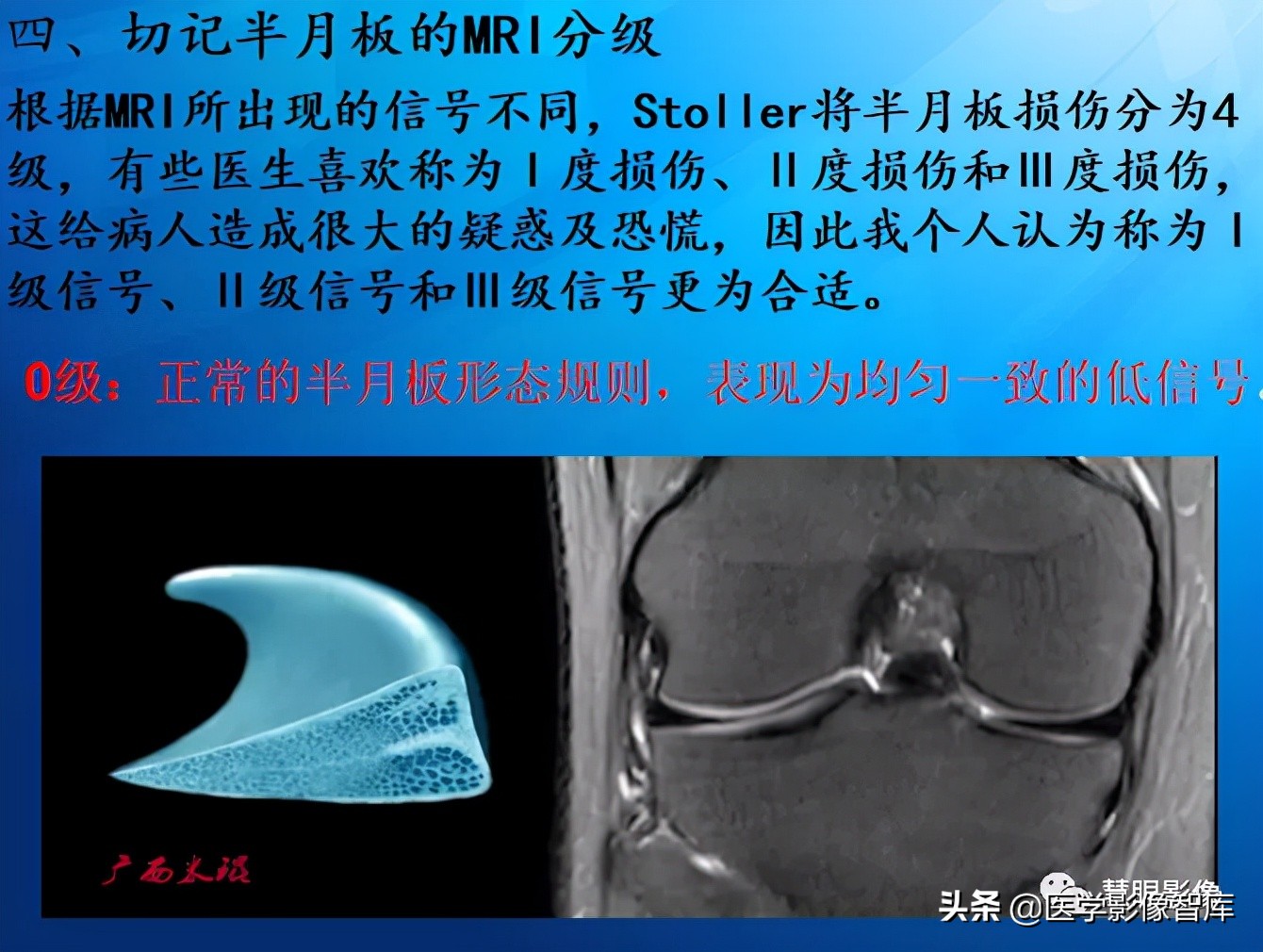膝关节半月板损伤的解剖结构图,半月板mri解剖图解