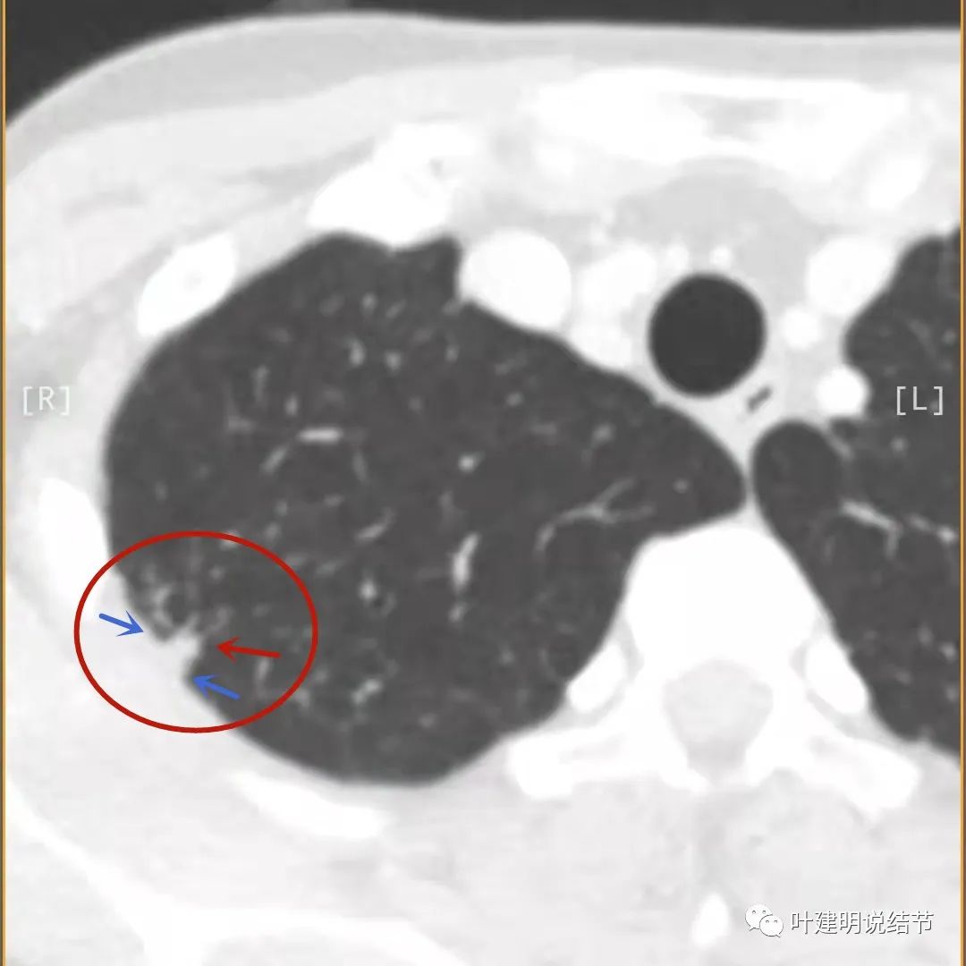 临床诊断孤立性肺结节,空洞型结节一般是什么性质