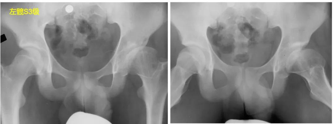 perthes可以治愈么,儿童股骨头坏死指南2020