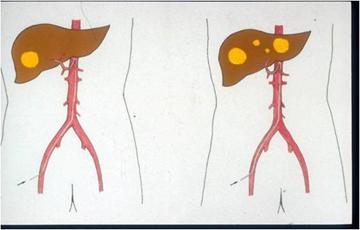 肝癌未转移手术切除后会再复发吗,肝癌肝移植后复发和转移哪个严重