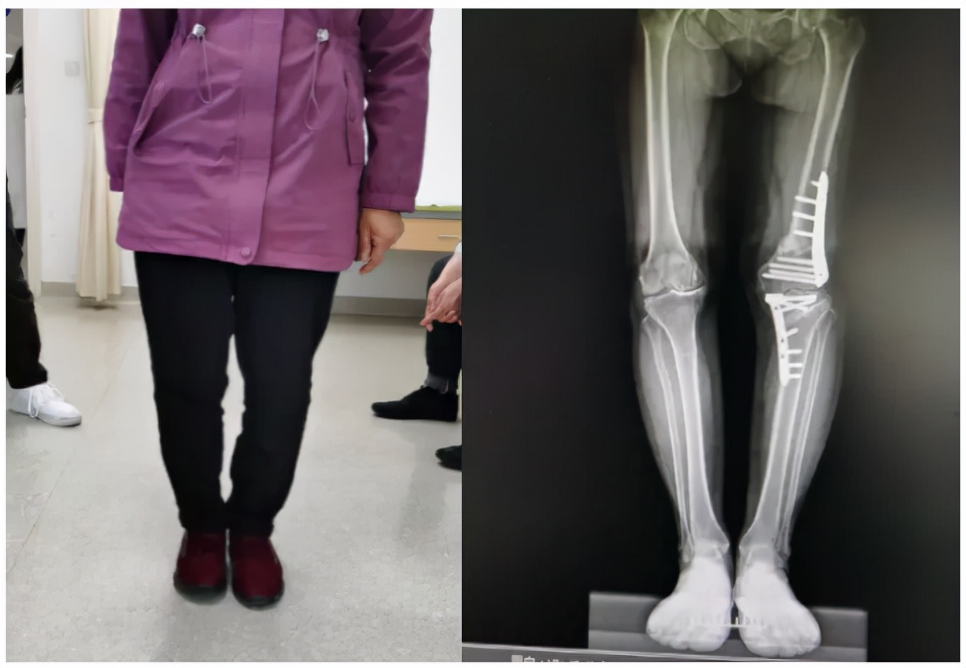 股骨和胫骨双部位截骨拯救复杂膝关节内翻畸形