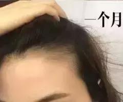 发际线后移的头发还能长出来么,头发发际线高还能长出来吗