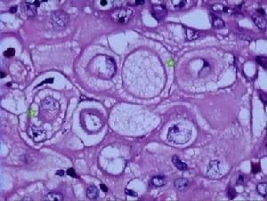 颅底软骨肉瘤和鼻咽癌有什么区别,颅底软骨肉瘤二级属于什么性质