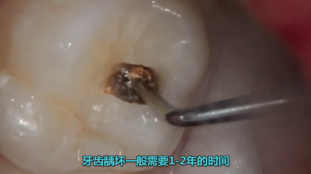 牙齿表面有小黑点内部一定坏了吗,根管治疗后牙齿有小黑点