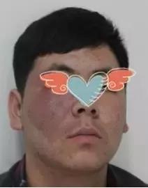 激光治疗红胎记几天能恢复,小孩身上长红胎记怎么回事