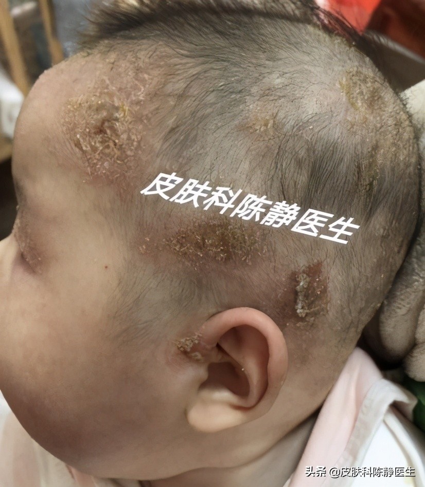 求治宝宝湿疹方法,宝宝湿疹给宝妈支招