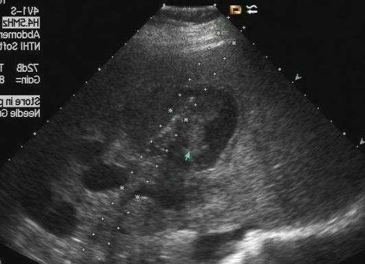 乙肝脸色发黄喝什么去黄,乙肝脸色发黄是怎么回事