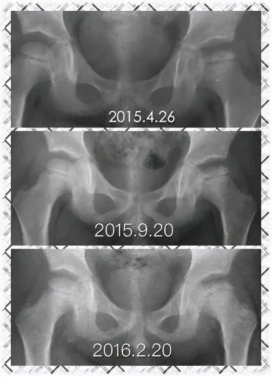 儿童医院儿童骨科,儿童骨科专家讲解