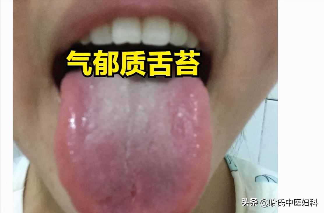 多囊卵巢综合征怀孕多久能测出来,多囊卵巢综合征怀孕了容易流产吗