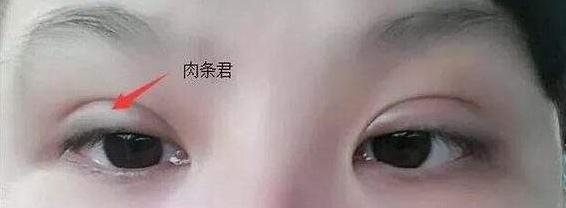 做完双眼皮为什么会有肉条感,做完双眼皮肉条感可以消除嘛