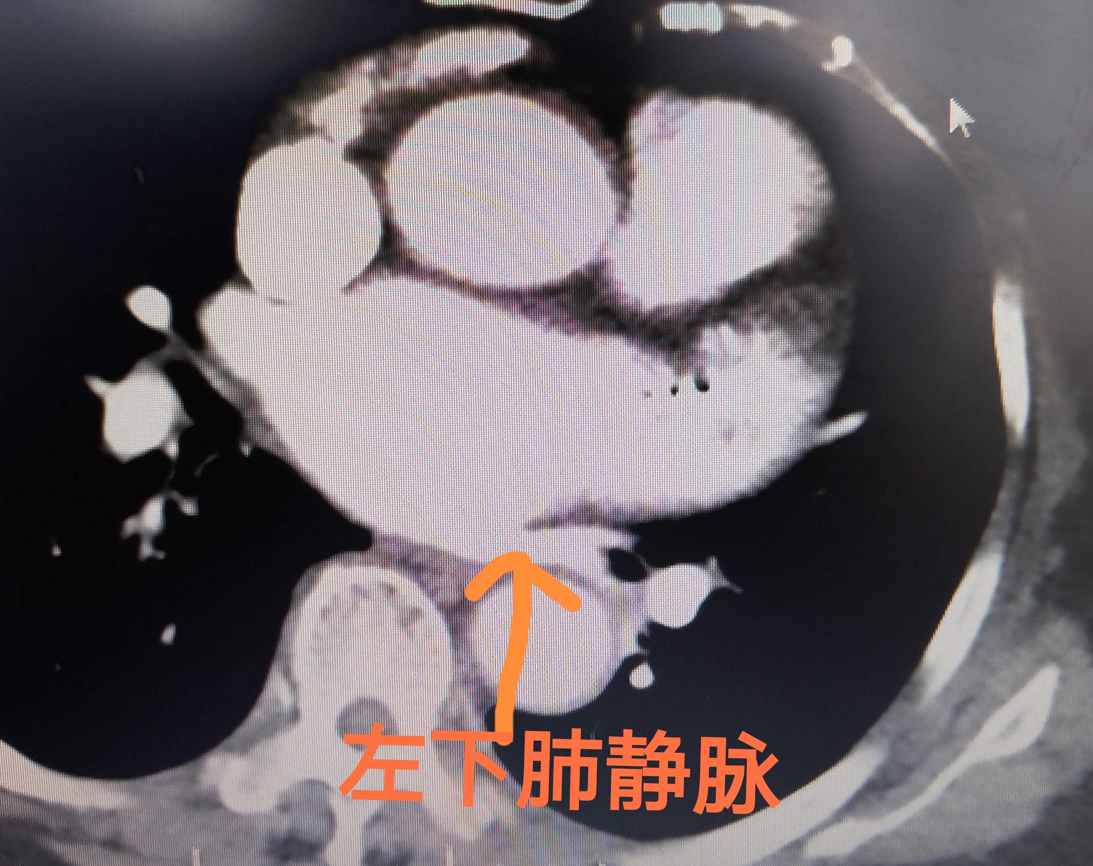 心血管病人吃伟哥,心血管病人可以用伟哥吗