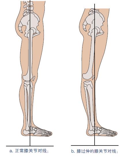 膝过伸自救指南：4个动作帮你改善膝过伸