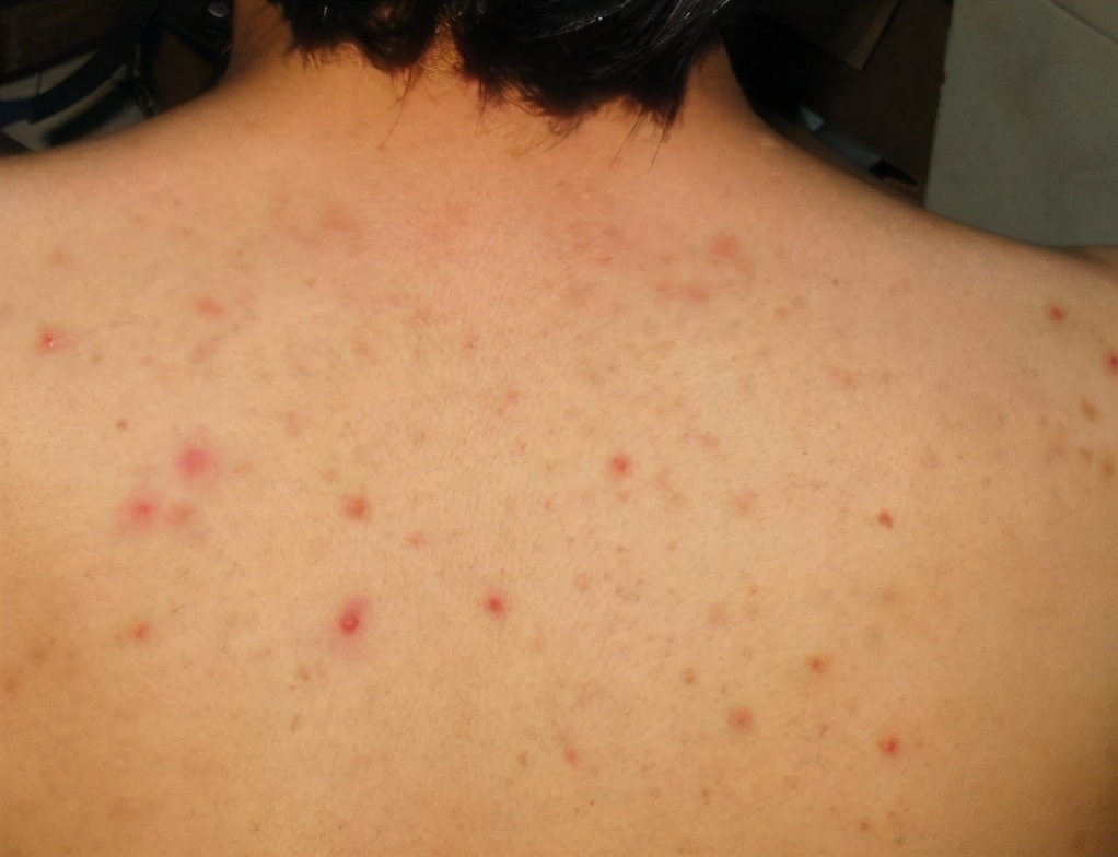 毛囊炎没得救?皮肤科主任推荐:3个便宜又好用的药,消除不反复