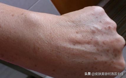 脸上有色斑应该怎么调理,脸上斑越来越多原因及治疗方法